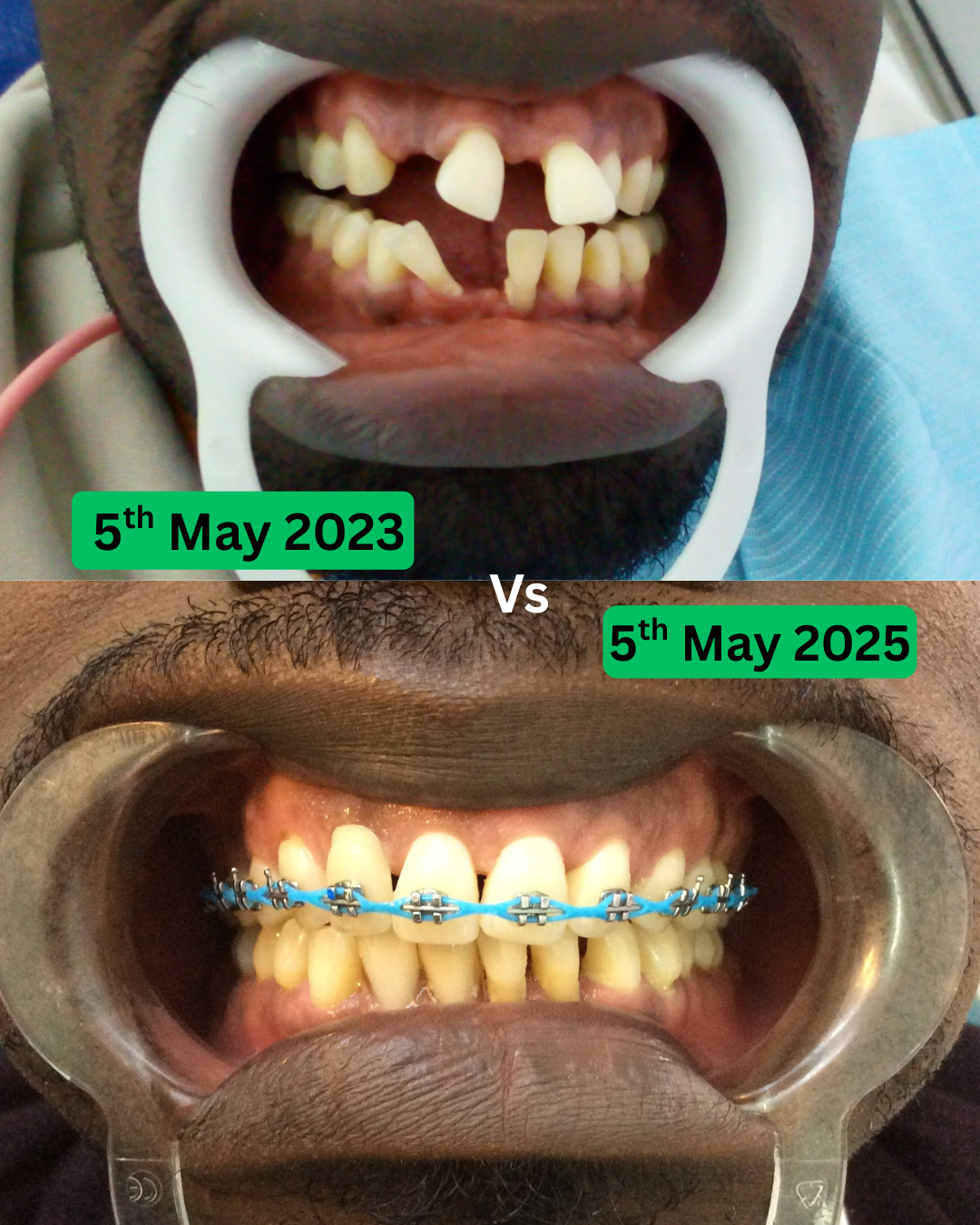 Braces transformation 7
